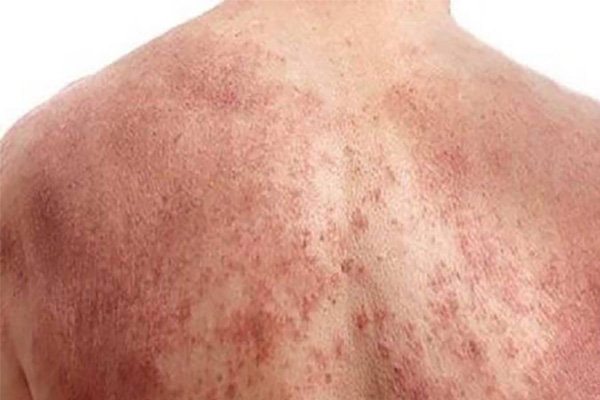 Phát ban đỏ lan rộng là dấu hiệu ban đầu của viêm da tiếp xúc bội nhiễm 
